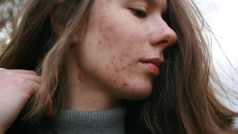 2026 Acne Medication Guide: Topical vs Oral Options