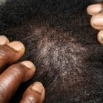 7 Natural Hair Growth Remedies That Work in 2026 for Thinning Hair