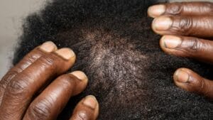 7 Natural Hair Growth Remedies That Work in 2026 for Thinning Hair