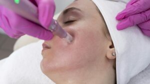 Acne Scars: Microneedling vs Laser Costs & Results 2026