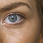 Hormonal Acne Treatment 2026: New OTC vs Prescription Options