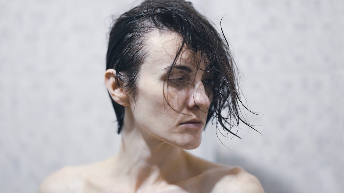 scalp acne