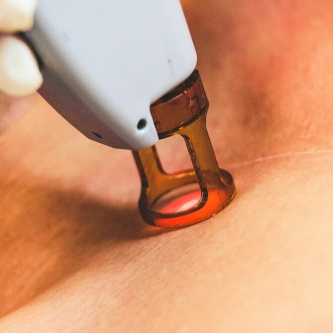 Laser vs Microneedling: Best Anti-Aging Treatments 2026