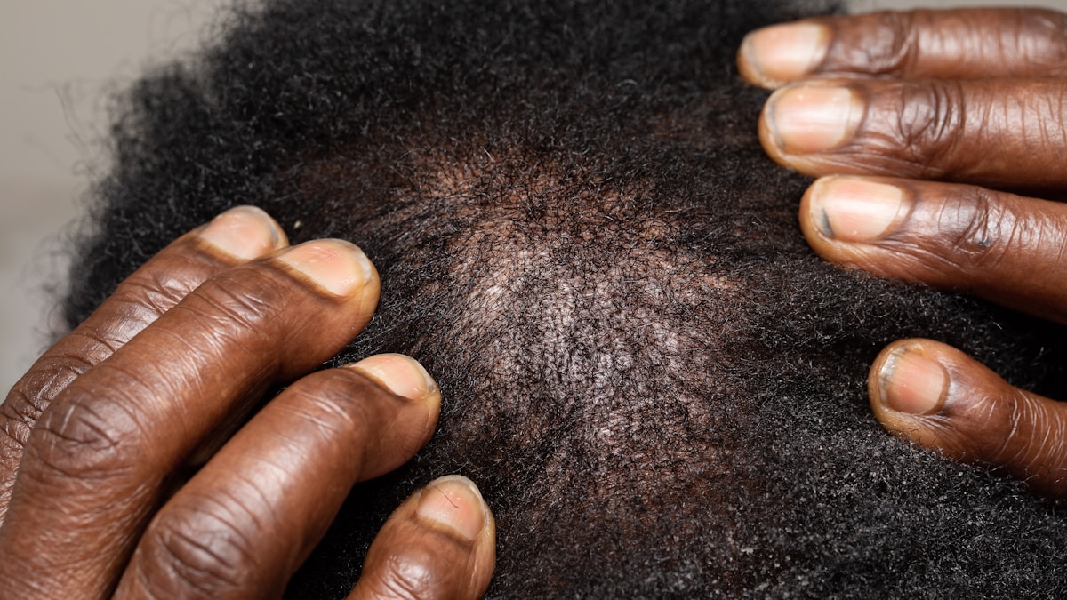Minoxidil vs Natural Oils