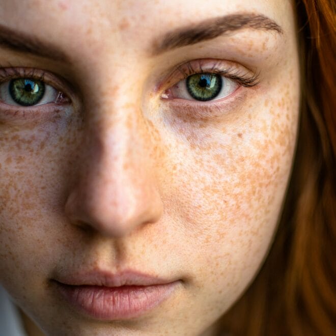 Spironolactone vs Salicylic Acid: Which Works for Hormonal Acne?