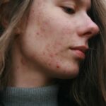Top Derm-Recommended Acne Treatments 2026 Under $50