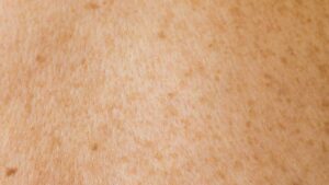 Why Bakuchiol Is Better Than Retinol for Sensitive Skin 2026