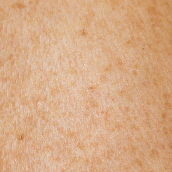Bakuchiol for Sensitive Skin: How to Switch from Retinol Without Irritation